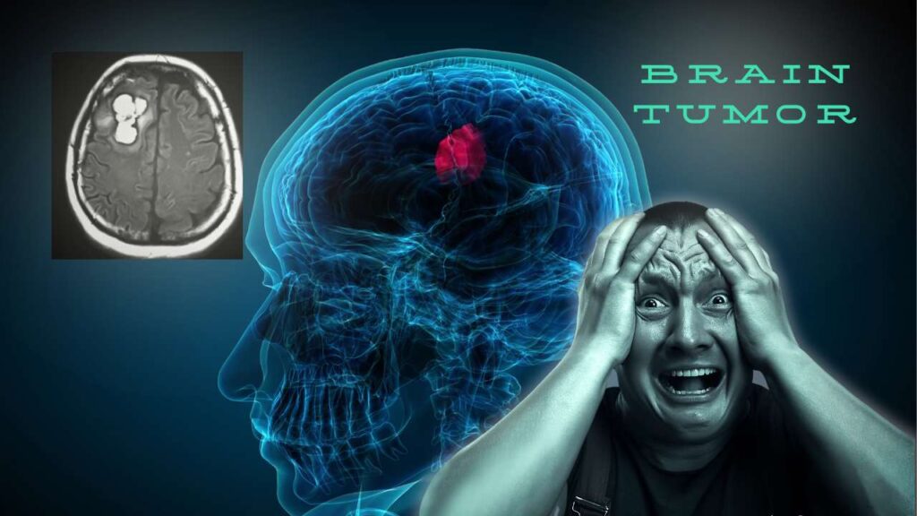 The Symptoms of Brain Tumor